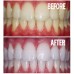 10 Tubes 44% Carbamide Peroxide Tooth Whitener Formula